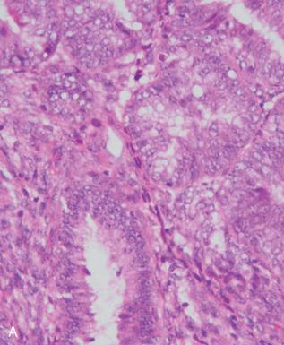 Fig. 19.2, A, Endometrioid adenocarcinoma. B, Absence of the PTEN tumor suppressor gene. Note the positive normal gland at left . C, Loss of PAX2 staining.