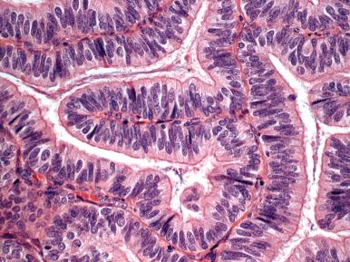 Fig. 19.21, Endometrial adenocarcinoma with tubal (ciliated) differentiation.