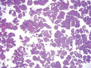 Fig. 19.23, Villoglandular adenocarcinoma. A, These tumors contain well-defined papillae lined by pseudostratified endometrioid epithelium. The degree of nuclear atypia is mild to moderate, with exfoliation of cohesive cell clusters rather than individual lining cells. B, Villoglandular adenocarcinoma with intraglandular papillae. C, Villoglandular adenocarcinoma with small foci of degenerative change, mimicking serous carcinoma.