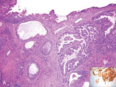Fig. 19.3, A, Uterine papillary serous carcinoma, with retention of p53 staining (inset) . B, Strong diffuse p16 staining and loss of PAX2 (C).