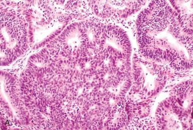 Fig. 19.4, Diagnosis of endometrial cancer. A, Confluent cribriform growth. B, Rambling glands. C, Villoglandular architecture. D, Conspicuous nuclear atypia. The latter might signify a serous type.