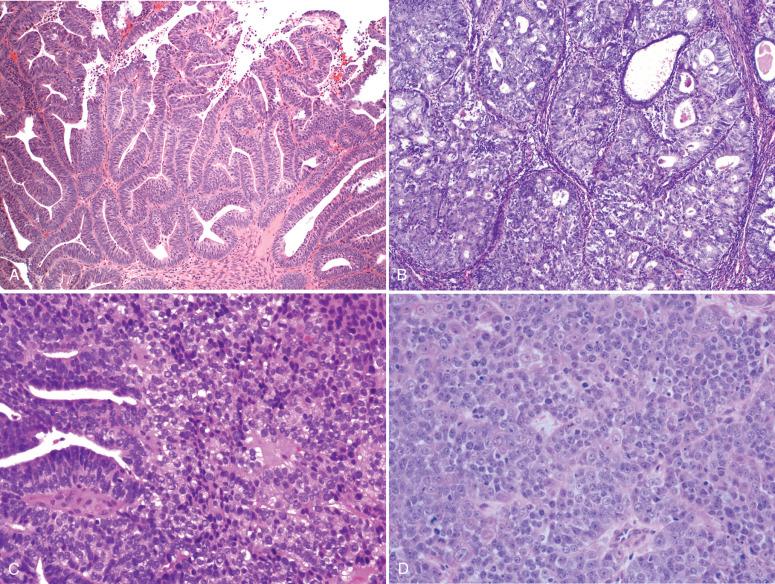 Fig. 19.5, Endometrial adenocarcinoma. A , B, Grade 1. C, Grade 2. D, Grade 3.