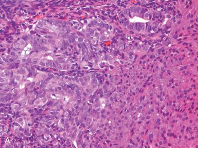 Fig. 19.7, Pitfalls in the interpretation of squamous differentiation. A, Squamous differentiation (lower right) does not alter the grade. B, Solid areas of adenocarcinoma might be misinterpreted as squamous differentiation. C, Some squamous differentiation can be so orderly and bland that it is misclassified as benign cervical metaplasia. D, Any mature squamous epithelium on the surface of the endometrium should be viewed with suspicion, like this focus distant to an endometrial adenocarcinoma.