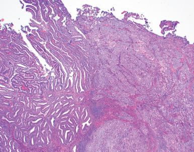 Fig. 19.8, Biphasic carcinoma with a sharp distinction between grade 1 and grade 3 components.