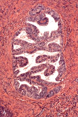 Fig. 19.10, Endometrioid adenocarcinoma (A) with weak or heterogeneous staining for p53 (B).