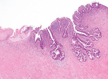 Fig. 6.1, Adenocarcinoma in situ. Marked hyperchromasia of the glands is readily evident on low power.