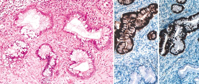 Fig. 6.11, Adenocarcinoma in situ (AIS), intestinal type. H&E appearance (left) with numerous goblet cells that are immunoreactive for p16 (center) and Ki-67 (right) although the staining for these markers is usually less intense than in typical AIS. In the immunostained sections, the benign endocervical glands are negative.