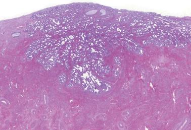 Fig. 6.12, Early invasive adenocarcinoma. The arrangement of the glands, one to another and with the stroma, is inconsistent with an in situ diagnosis.