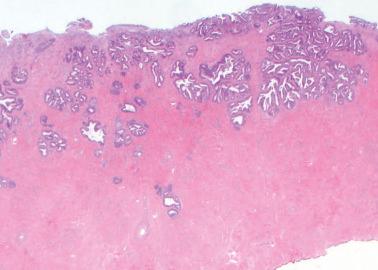 Fig. 6.13, Early invasive endocervical adenocarcinoma. Focally there is too much confluence of the neoplastic glands for in situ neoplasia (right) and a few deep glands are also indicative of invasion.