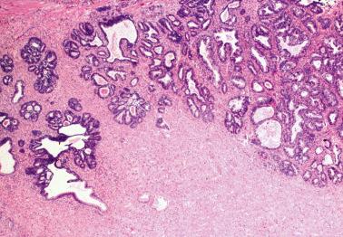 Fig. 6.14, Early invasive adenocarcinoma. Foci of adenocarcinoma in situ (left) merge with confluent malignant glands (right), a pattern indicating invasion.