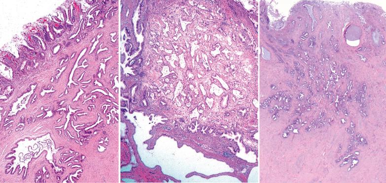 Fig. 6.15, Early invasive adenocarcinomas, three different cases. Left: The invasive glands have an infiltrative pattern that is inconsistent with glands involved by adenocarcinoma in situ. Center: A tiny invasive adenocarcinoma that is obviously invasive in view of its infiltrative pattern and a desmoplastic stroma. Right: Irregularly shaped, focally crowded, glands have an arrangement indicative of stromal invasion despite the lack of an appreciable stromal reaction.