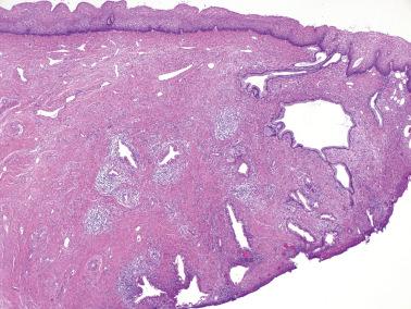 Fig. 6.17, Invasive endocervical adenocarcinoma of usual type. An overt stromal reaction with inflammatory infiltrate is present in association with many of the invasive glands.