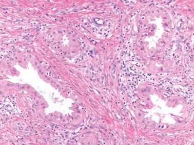 Fig. 6.18, Invasive endocervical adenocarcinoma of usual type. Higher power view of the previous case demonstrates glands lined by cells with conspicuous eosinophilic cytoplasm, an occasional appearance of invasive glands.