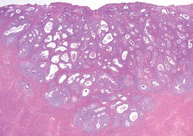 Fig. 6.19, Invasive endocervical adenocarcinoma of usual type.