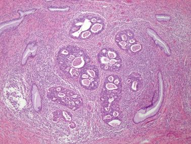 Fig. 6.20, Invasive endocervical adenocarcinoma of usual type. Higher power of the previous case demonstrates a prominent cribriform pattern.