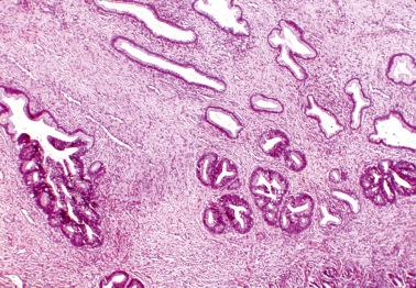 Fig. 6.2, Adenocarcinoma in situ. The involved glands (lower half of field) are more darkly staining than the normal glands (upper half of field). One gland (extreme left) is partly involved.