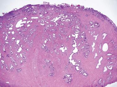 Fig. 6.21, Invasive endocervical adenocarcinoma of usual type. Occasionally the glands grow in a somewhat linear fashion within the cervical stroma.