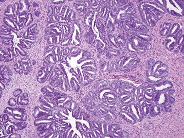 Fig. 6.22, Invasive endocervical adenocarcinoma of usual type. A striking cribriform pattern is present in this case.