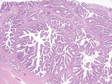 Fig. 6.23, Invasive endocervical adenocarcinoma of usual type. Villous papillae are conspicuous.