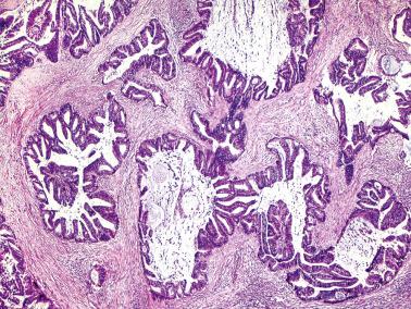 Fig. 6.24, Invasive endocervical adenocarcinoma of usual type. Anastomosing glands with focal cribriform pattern and luminal mucin are seen.