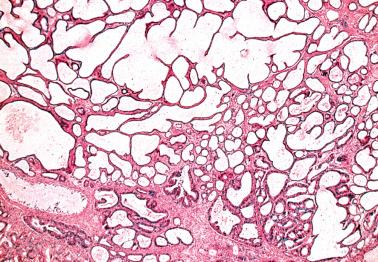 Fig. 6.25, Invasive endocervical adenocarcinoma, microcystic pattern. Many of the neoplastic glands are cystic and have a deceptively benign appearance. The microcystic glands merge with foci of more typical adenocarcinoma at the bottom of the field.