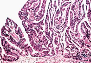 Fig. 6.26, Endocervical adenocarcinoma of usual type with a villous pattern.