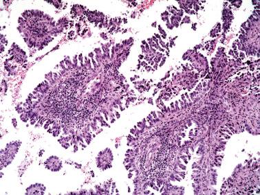 Fig. 6.27, Invasive endocervical adenocarcinoma of usual type. A tufted-micropapillary pattern is prominent in some cases.