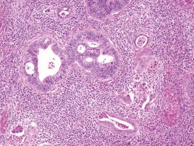 Fig. 6.28, Invasive endocervical adenocarcinoma of usual type. In additional to a cribriform pattern, this illustration shows angulated glands, a microcystic gland, and clusters of individual cells.