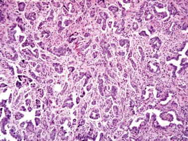 Fig. 6.29, Invasive endocervical adenocarcinoma of usual type. A few conventional glands are seen but the predominant pattern, an uncommon one, is characterized by small clusters of neoplastic cells focally having a micropapillary pattern.