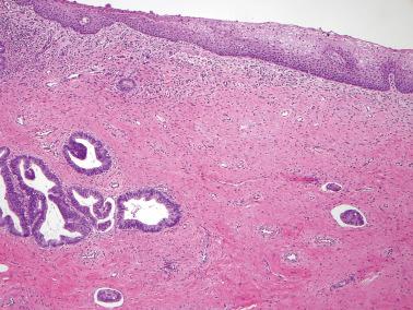 Fig. 6.30, Invasive endocervical adenocarcinoma with vascular space invasion.