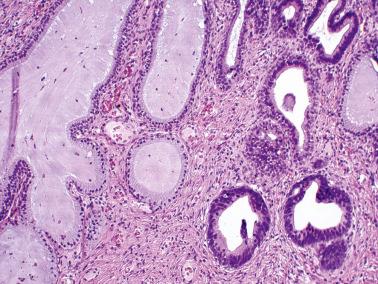 Fig. 6.3, Adenocarcinoma in situ. The cellular stratification, atypia, and cytoplasmic eosinophilia of the involved glands (right) contrast with normal endocervical glands (left).