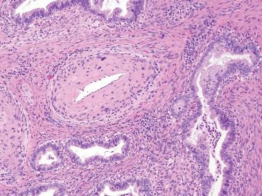 Fig. 6.31, Invasive endocervical adenocarcinoma of usual type. Proximity of glands to thick-walled vasculature may be a clue to the diagnosis of invasion.