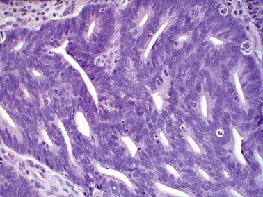 Fig. 6.32, Invasive endocervical adenocarcinoma of usual type. Several characteristic features are seen: amphophilic cytoplasm, basilar apoptosis, and apical (‘floating’) mitoses.