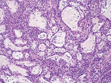 Fig. 6.33, Invasive endocervical adenocarcinoma of usual type, microglandular pattern. The presence of luminal mucin with inflammatory cells imparts a resemblance to microglandular hyperplasia.