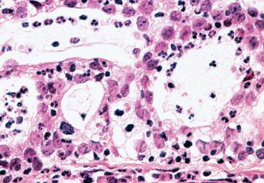 Fig. 6.34, Invasive endocervical adenocarcinoma of usual type, microglandular pattern. A high-power view of tumor in the prior illustration shows malignant cytologic features inconsistent with microglandular hyperplasia.