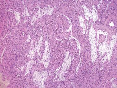 Fig. 6.35, Endocervical adenocarcinoma of usual type post radiation therapy. Drop out of the neoplastic epithelial cells results in pools of mucin and may result in a diagnosis of cancer being overlooked.