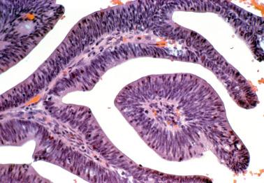 Fig. 6.36, Endocervical adenocarcinoma, well-differentiated villoglandular type. The tumor has low-grade nuclear features, a definitional feature of the tumor.