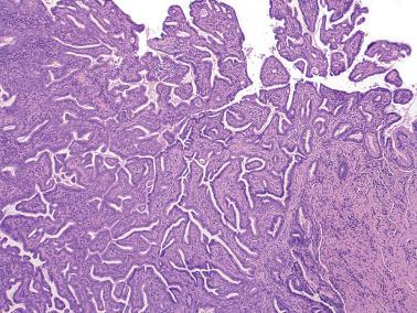 Fig. 6.37, Endocervical adenocarcinoma, well-differentiated villoglandular type. The invasive component often is in the form of elongated branching glands.