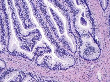 Fig. 6.38, Invasive endocervical adenocarcinoma, mucinous type, NOS.