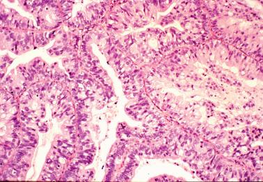 Fig. 6.39, Invasive endocervical adenocarcinoma, mucinous type, NOS. The cytoplasm of the tumor cells contains mucin, a finding highlighted by strong cytoplasmic positivity with a PASD stain (not shown).