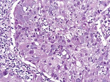 Fig. 6.40, Invasive endocervical adenocarcinoma, mucinous type, NOS. Occasionally the neoplastic cells are not columnar but still engorged with mucin.