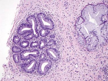 Fig. 6.4, Adenocarcinoma in situ. A group of involved glands (left) shows classic cytologic features but maintains a lobular architecture.