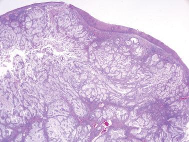 Fig. 6.41, Invasive mucinous carcinoma, gastric type. The cervical stroma is largely effaced by a complex growth of closely packed relatively differentiated mucinous glands.