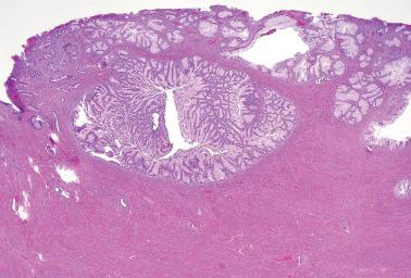 Fig. 6.42, Invasive mucinous carcinoma, gastric type. A deceptively bland appearing circumscribed lobule of neoplastic glands is present.