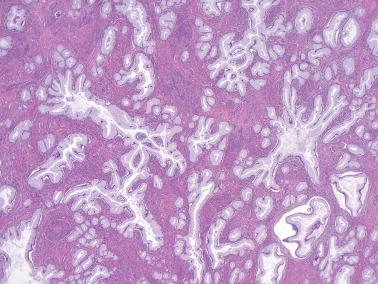 Fig. 6.43, Invasive mucinous carcinoma, gastric type (adenoma malignum). Irregularly branching glands with outpouchings infiltrate throughout the cervical stroma without a surrounding reaction. Note the highly differentiated nature of the neoplastic epithelium (so-called adenoma malignum).