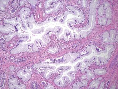 Fig. 6.44, Invasive mucinous carcinoma, gastric type (adenoma malignum). Nearly all the glands are highly differentiated, but a few (bottom left) show appreciable atypia.