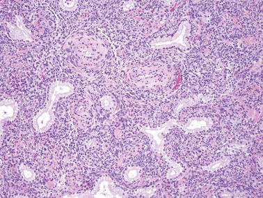 Fig. 6.45, Invasive mucinous carcinoma, gastric type. Deceptively benign-appearing neoplastic glands are in close proximity to a thick-walled blood vessel, a helpful clue to the presence of definite invasion in cervical adenocarcinoma, including adenoma malignum.