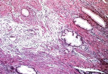 Fig. 6.46, Invasive mucinous carcinoma, gastric type (adenoma malignum). Some glands are surrounded by a loose reactive stroma. Note benign morphology of glands unassociated with reactive stroma but which are also malignant.