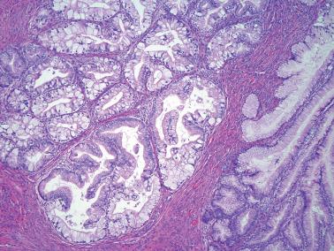 Fig. 6.47, Invasive mucinous carcinoma, gastric type. This example shows more overt cytologic atypia and cellular stratification than present in the prior illustrations of this variant.