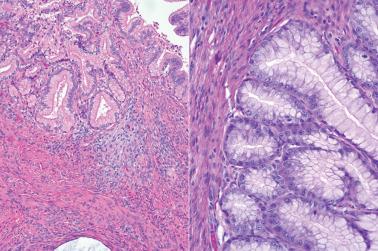 Fig. 6.48, Invasive mucinous carcinoma, gastric type. Left: Lightly eosinophilic cytoplasm characterizes this focus of pyloric differentiation. Right: High-power scrutiny of the glands shows prominent nucleoli in a number of the basal epithelial cells as well as occasional mitotic figures.